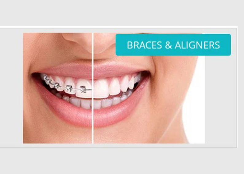 Best Dental Braces Treatment In Delhi NCR