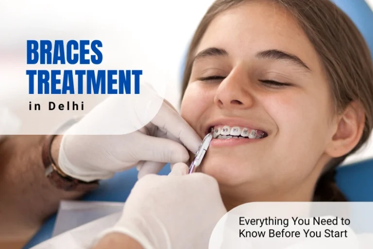 Braces Treatment in Delhi